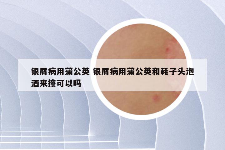 银屑病用蒲公英 银屑病用蒲公英和耗子头泡酒来擦可以吗