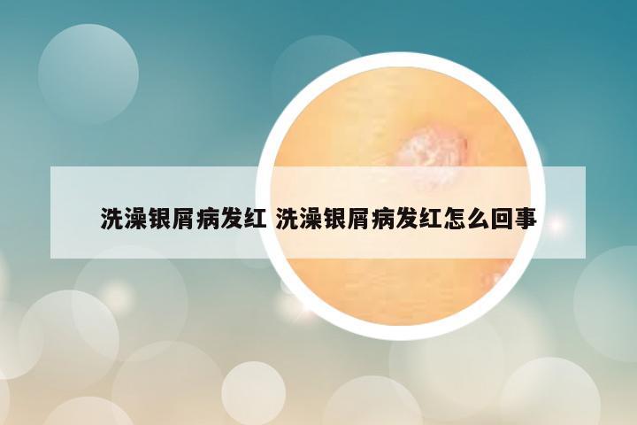洗澡银屑病发红 洗澡银屑病发红怎么回事
