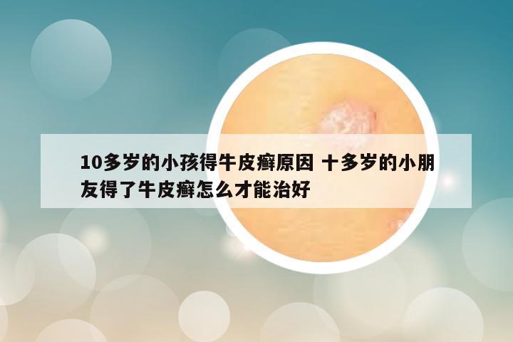 10多岁的小孩得牛皮癣原因 十多岁的小朋友得了牛皮癣怎么才能治好