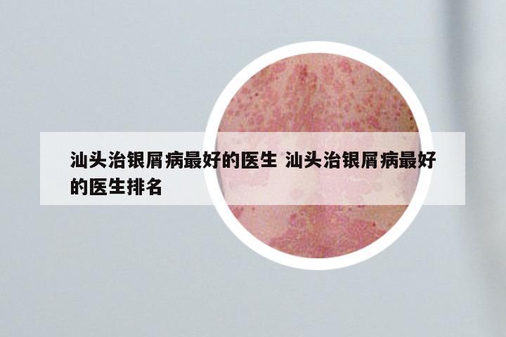 汕头治银屑病最好的医生 汕头治银屑病最好的医生排名