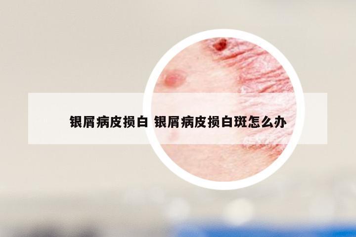 银屑病皮损白 银屑病皮损白斑怎么办
