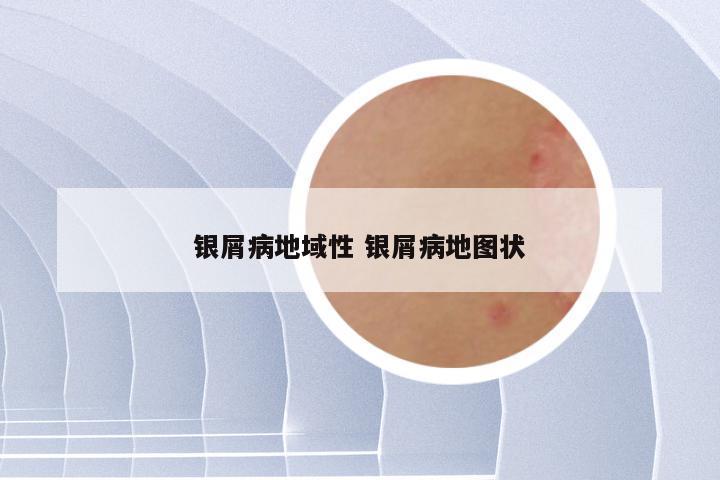 银屑病地域性 银屑病地图状