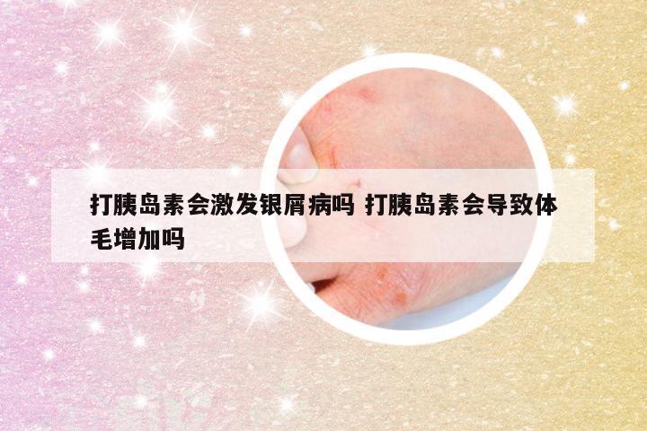 打胰岛素会激发银屑病吗 打胰岛素会导致体毛增加吗