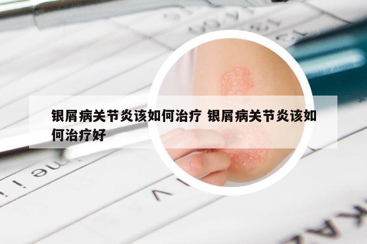 银屑病关节炎该如何治疗 银屑病关节炎该如何治疗好