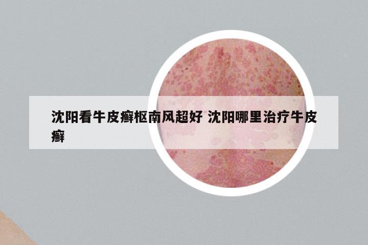 沈阳看牛皮癣枢南风超好 沈阳哪里治疗牛皮癣