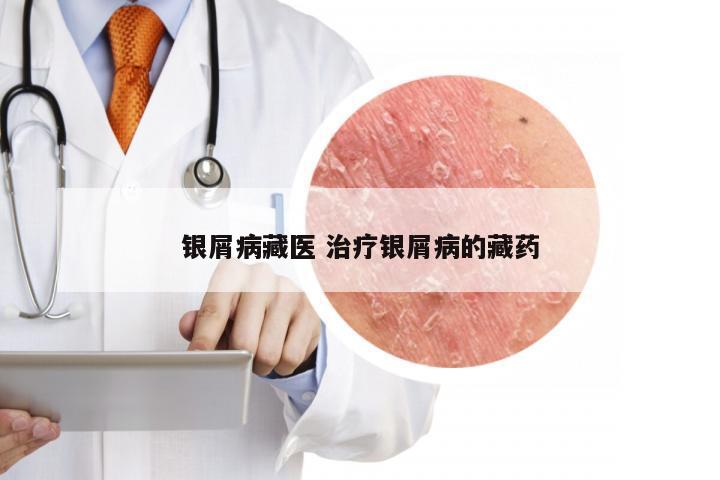 银屑病藏医 治疗银屑病的藏药
