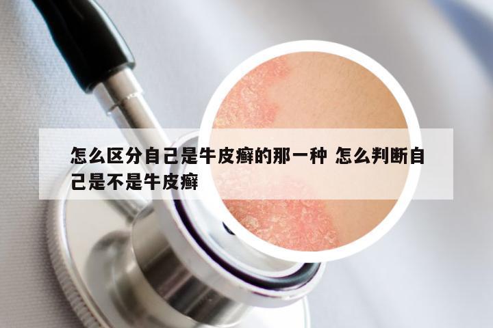 怎么区分自己是牛皮癣的那一种 怎么判断自己是不是牛皮癣