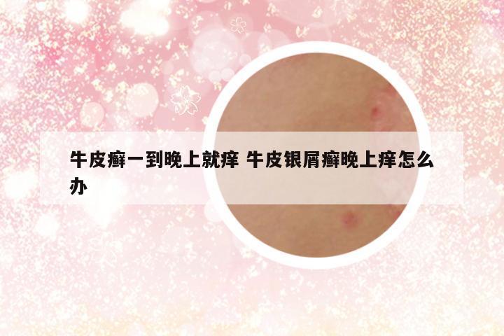 牛皮癣一到晚上就痒 牛皮银屑癣晚上痒怎么办