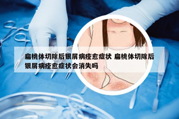 扁桃体切除后银屑病痊愈症状 扁桃体切除后银屑病痊愈症状会消失吗