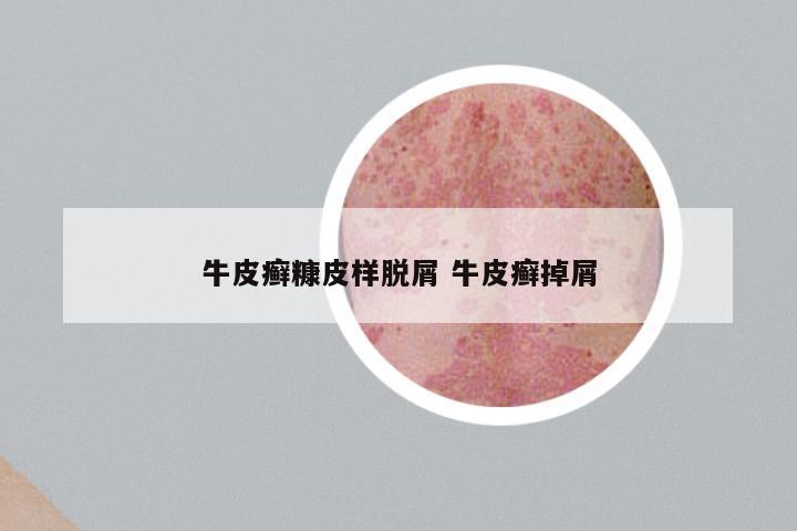 牛皮癣糠皮样脱屑 牛皮癣掉屑