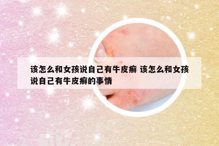 该怎么和女孩说自己有牛皮癣 该怎么和女孩说自己有牛皮癣的事情