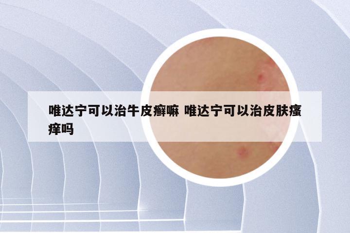唯达宁可以治牛皮癣嘛 唯达宁可以治皮肤瘙痒吗