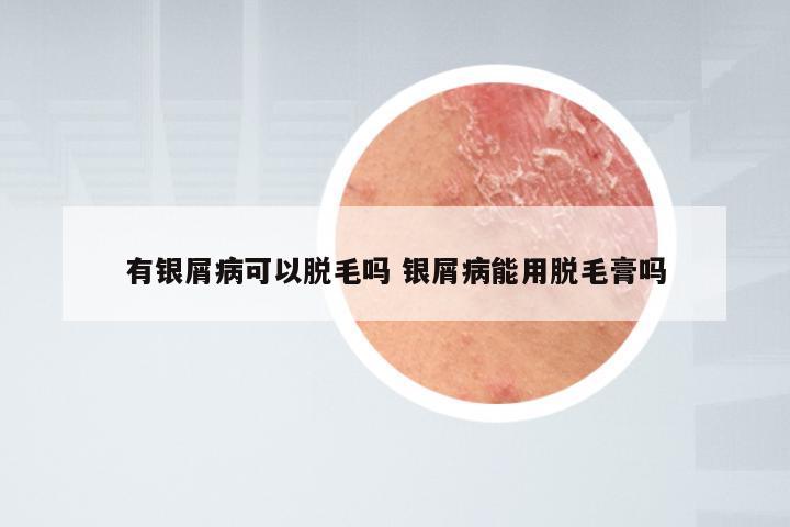 有银屑病可以脱毛吗 银屑病能用脱毛膏吗