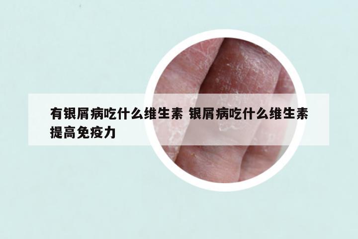 有银屑病吃什么维生素 银屑病吃什么维生素提高免疫力