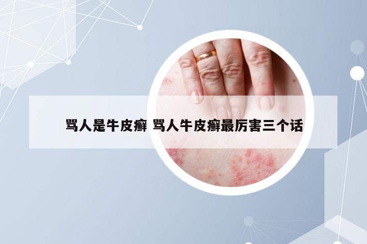 骂人是牛皮癣 骂人牛皮癣最厉害三个话