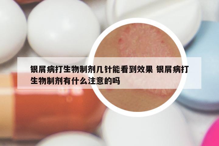 银屑病打生物制剂几针能看到效果 银屑病打生物制剂有什么注意的吗