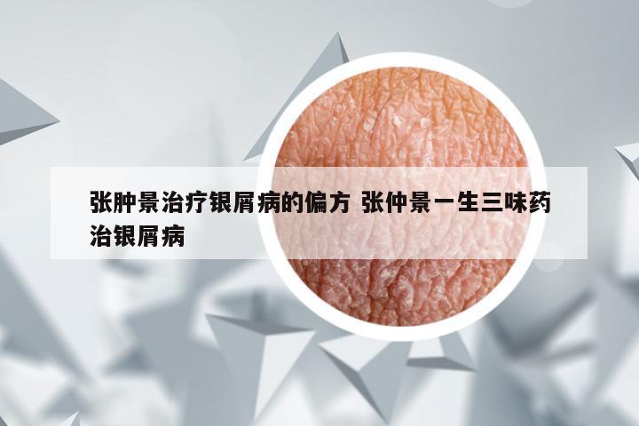 张肿景治疗银屑病的偏方 张仲景一生三味药治银屑病