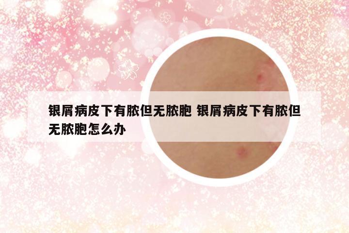 银屑病皮下有脓但无脓胞 银屑病皮下有脓但无脓胞怎么办