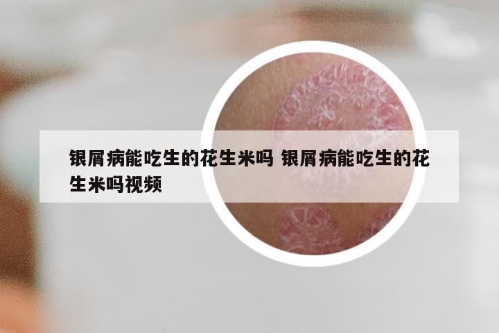 银屑病能吃生的花生米吗 银屑病能吃生的花生米吗视频