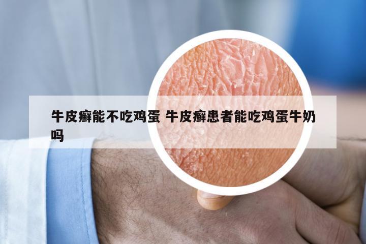 牛皮癣能不吃鸡蛋 牛皮癣患者能吃鸡蛋牛奶吗