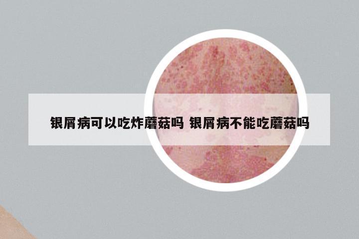 银屑病可以吃炸蘑菇吗 银屑病不能吃蘑菇吗