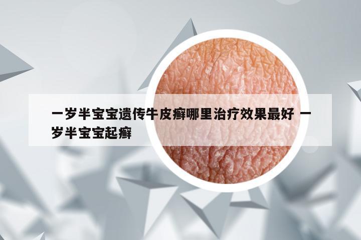 一岁半宝宝遗传牛皮癣哪里治疗效果最好 一岁半宝宝起癣