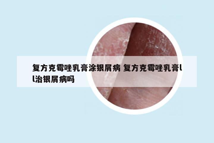 复方克霉唑乳膏涂银屑病 复方克霉唑乳膏ll治银屑病吗