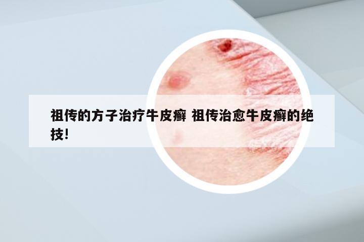 祖传的方子治疗牛皮癣 祖传治愈牛皮癣的绝技!