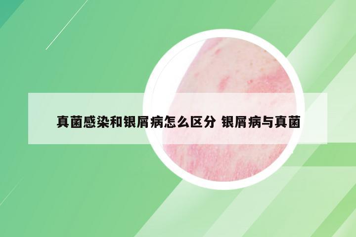真菌感染和银屑病怎么区分 银屑病与真菌