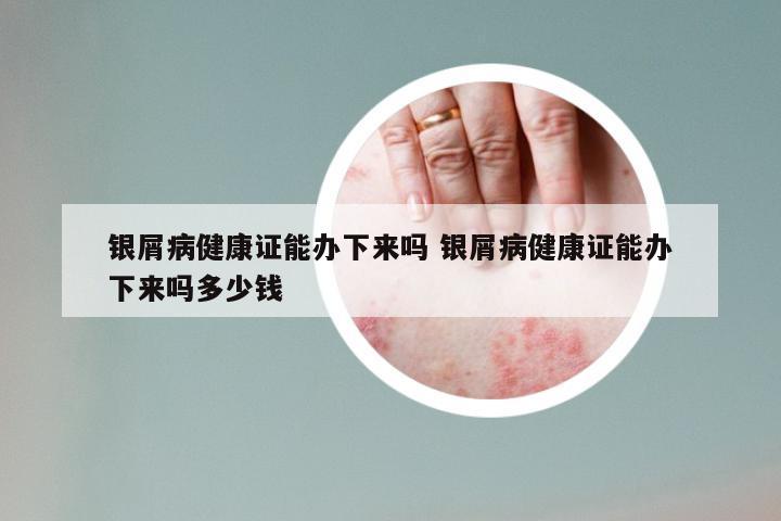 银屑病健康证能办下来吗 银屑病健康证能办下来吗多少钱