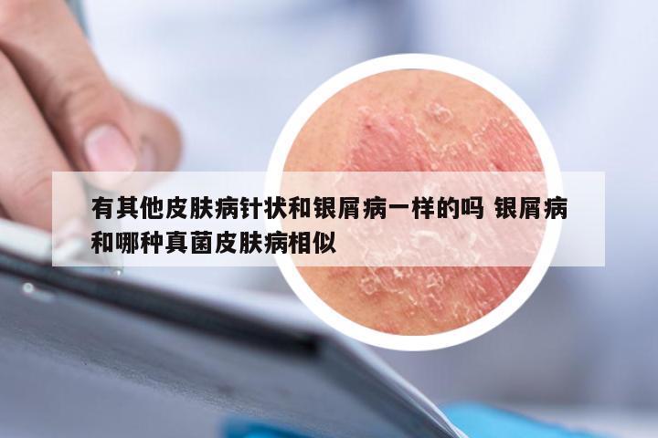 有其他皮肤病针状和银屑病一样的吗 银屑病和哪种真菌皮肤病相似