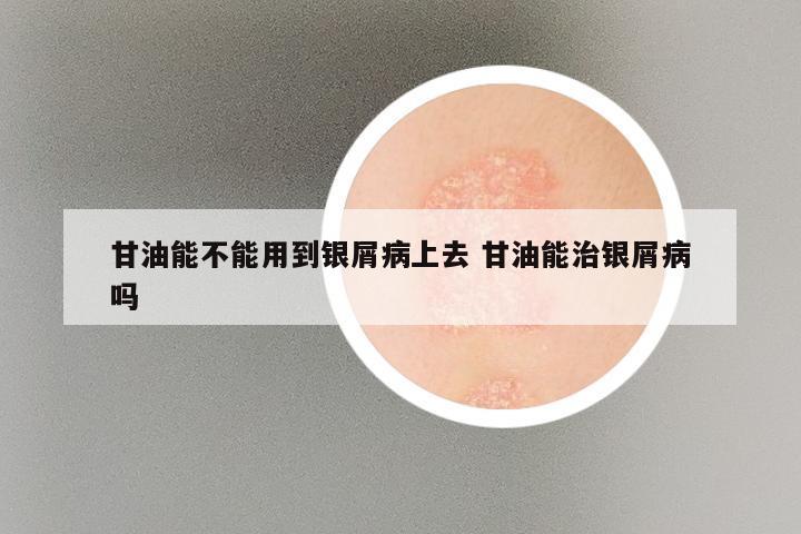 甘油能不能用到银屑病上去 甘油能治银屑病吗
