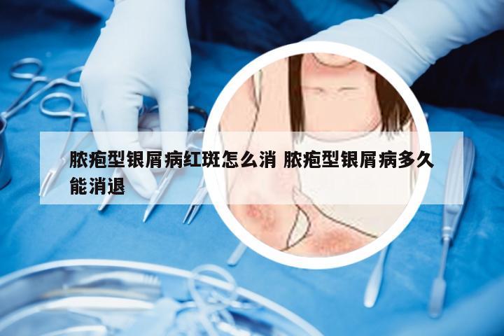 脓疱型银屑病红斑怎么消 脓疱型银屑病多久能消退