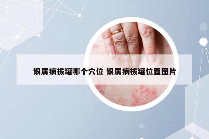 银屑病拔罐哪个穴位 银屑病拔罐位置图片