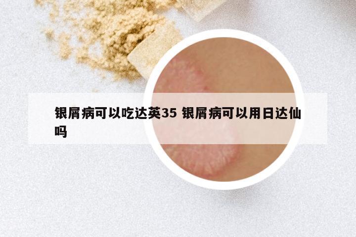 银屑病可以吃达英35 银屑病可以用日达仙吗