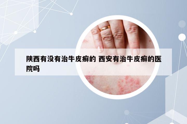 陕西有没有治牛皮癣的 西安有治牛皮癣的医院吗