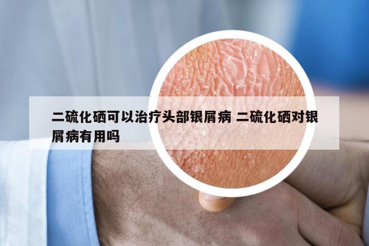 二硫化硒可以治疗头部银屑病 二硫化硒对银屑病有用吗