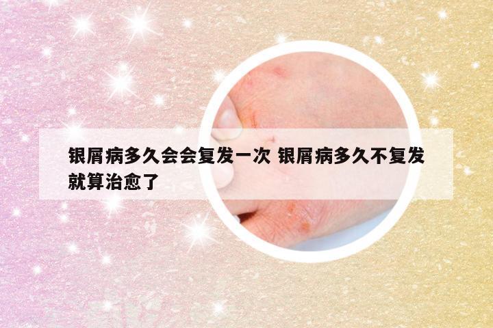 银屑病多久会会复发一次 银屑病多久不复发就算治愈了