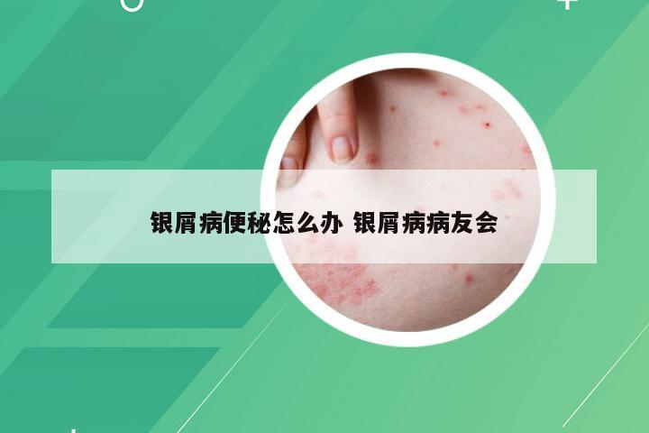 银屑病便秘怎么办 银屑病病友会