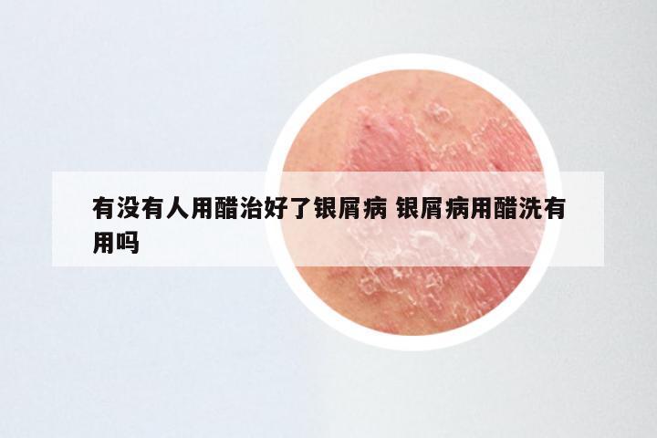 有没有人用醋治好了银屑病 银屑病用醋洗有用吗