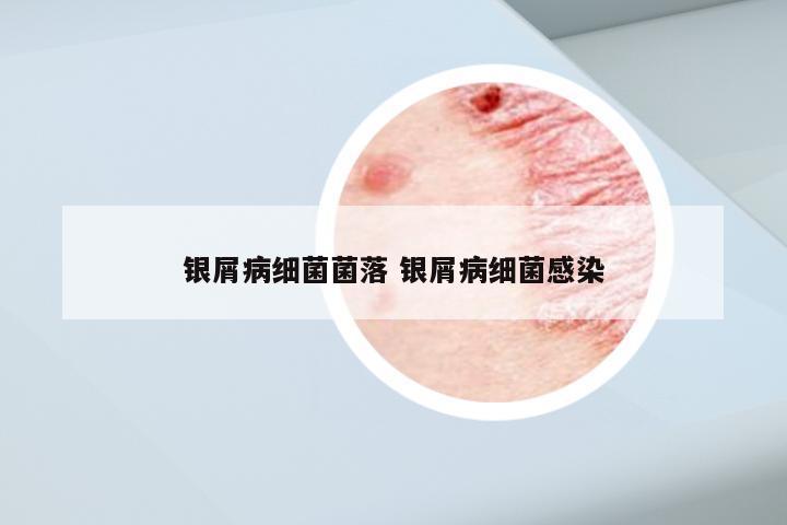 银屑病细菌菌落 银屑病细菌感染