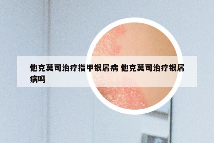 他克莫司治疗指甲银屑病 他克莫司治疗银屑病吗