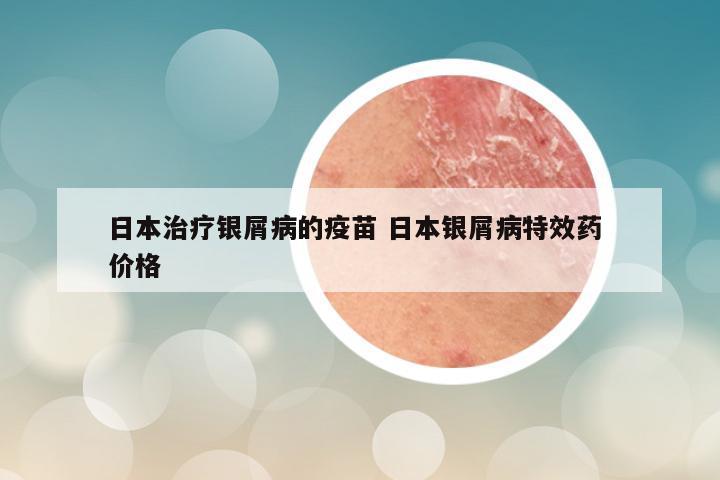 日本治疗银屑病的疫苗 日本银屑病特效药 价格