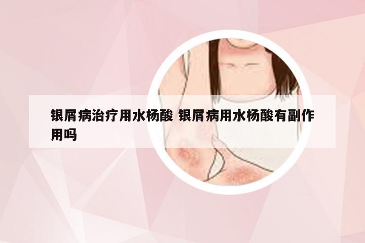 银屑病治疗用水杨酸 银屑病用水杨酸有副作用吗