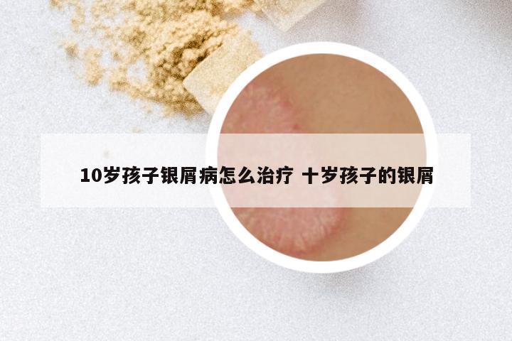 10岁孩子银屑病怎么治疗 十岁孩子的银屑