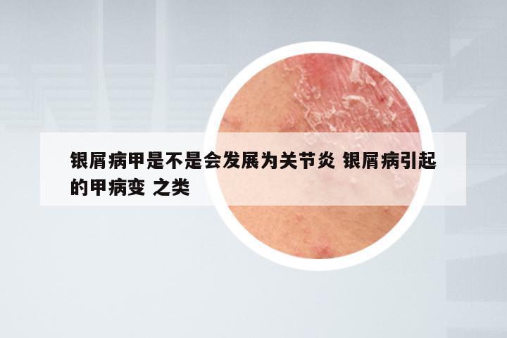 银屑病甲是不是会发展为关节炎 银屑病引起的甲病变 之类