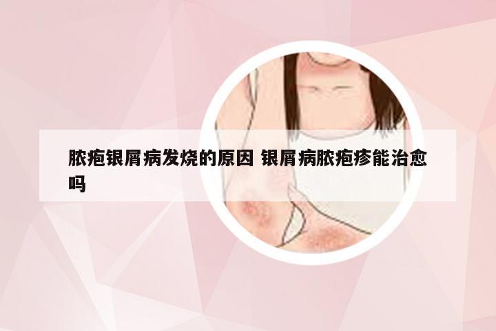 脓疱银屑病发烧的原因 银屑病脓疱疹能治愈吗
