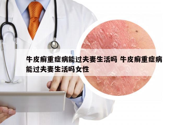 牛皮癣重症病能过夫妻生活吗 牛皮癣重症病能过夫妻生活吗女性