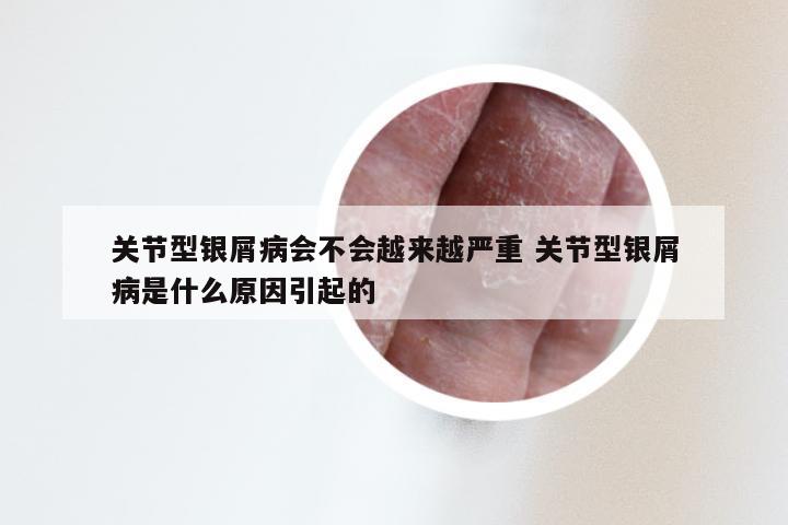 关节型银屑病会不会越来越严重 关节型银屑病是什么原因引起的