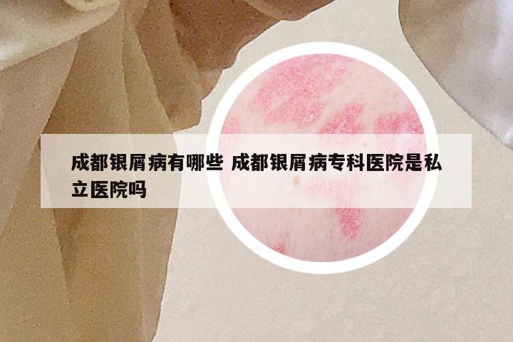 成都银屑病有哪些 成都银屑病专科医院是私立医院吗